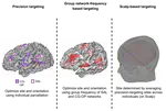 Precision Brain Mapping for Personalized TMS Targeting